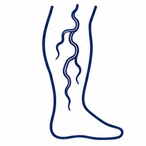 Varicose Veins